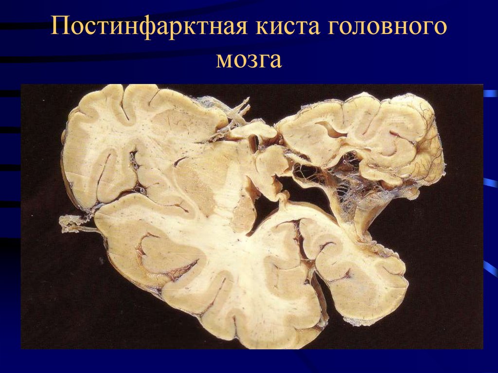 Киста мозга рассосалась. Киста головного мозга патанатомия. Ишемический инфаркт мозга макропрепарат. Киста головного мозга макропрепарат. Кисла головного мозга патанат.