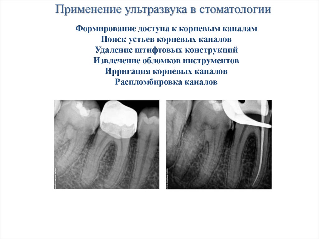 Применение ультразвука в стоматологии