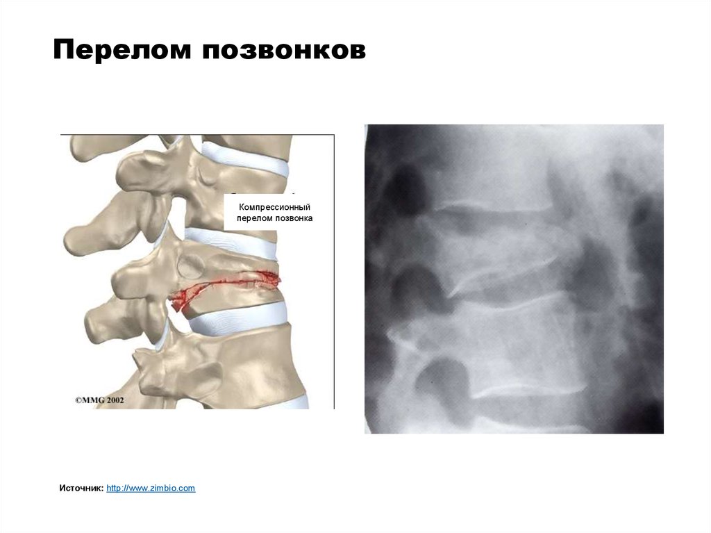 Компрессия тела позвонка