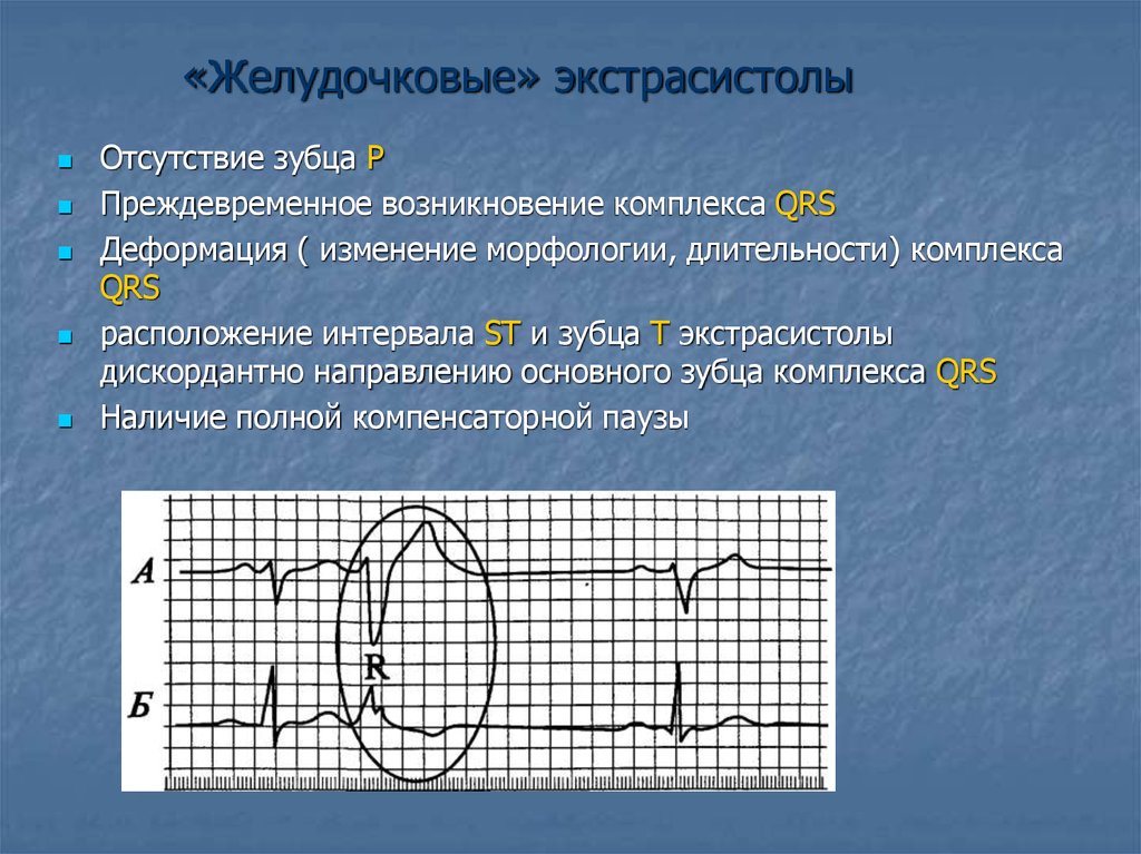 Ранний желудочков