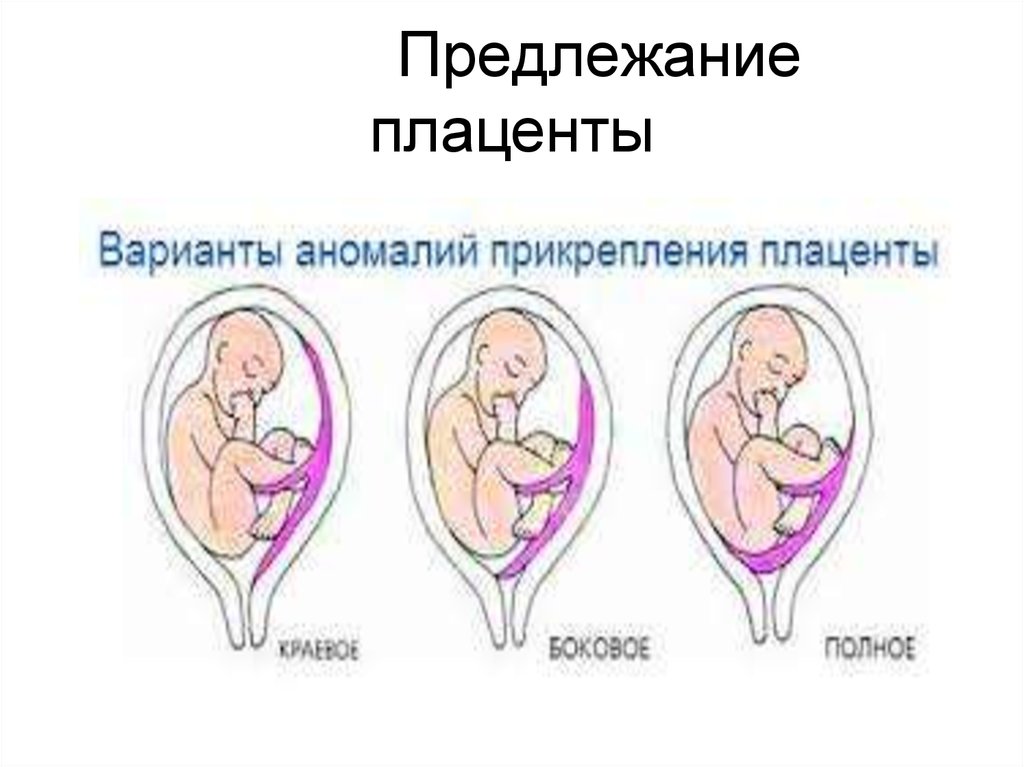 Полное предлежание при беременности. Плацента краевое предлежание плаценты. Краевое предлежание плода. Краевое предлежание плаценты 21 неделя. Краевое прикрепление плаценты.