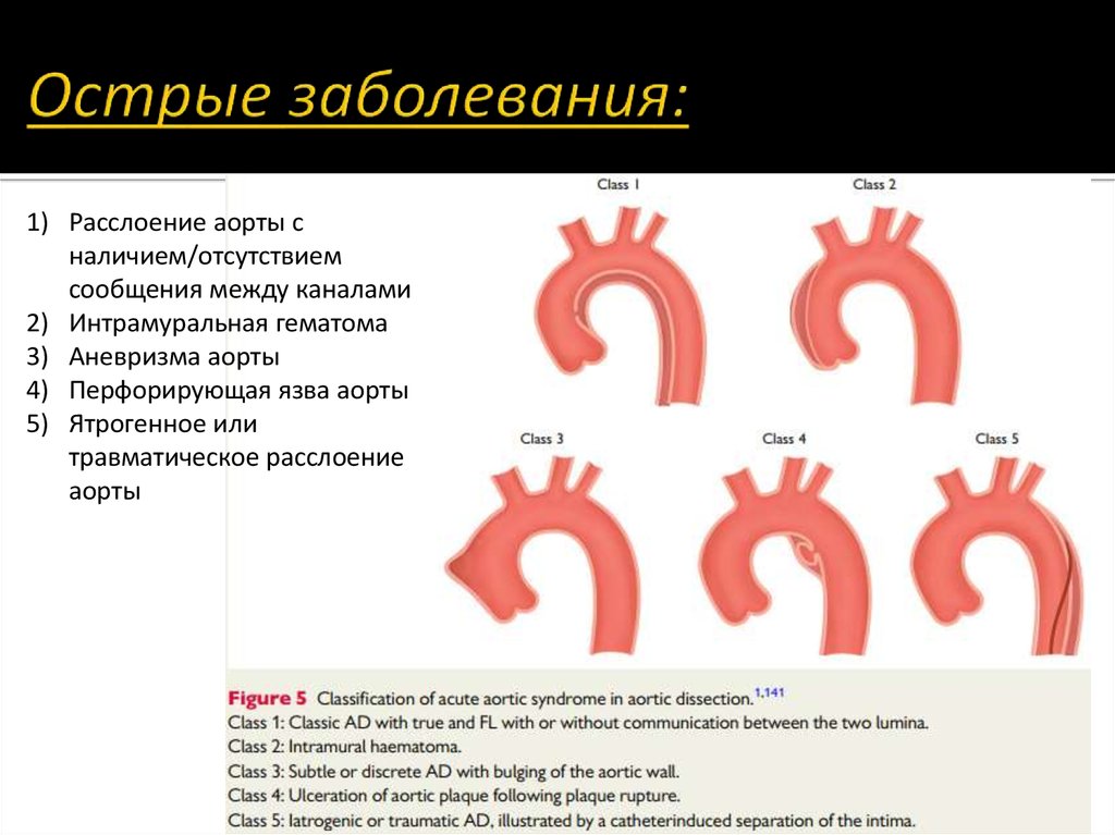 Аорта клинические рекомендации