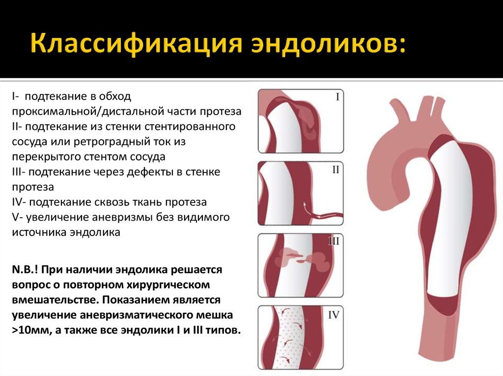 Расслаивающаяся аневризма аорты презентация