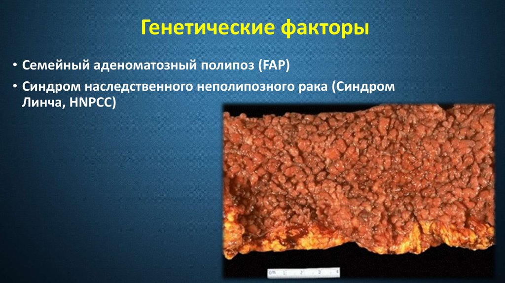 Диффузные факторы. Семейный аденоматозный полипоз. Наследственный аденоматозный полипоз. Семейный наследственный полипоз.