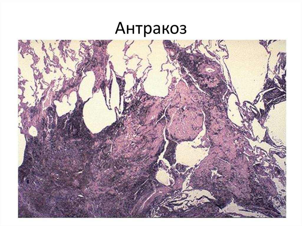 Силикоз легкого микропрепарат рисунок