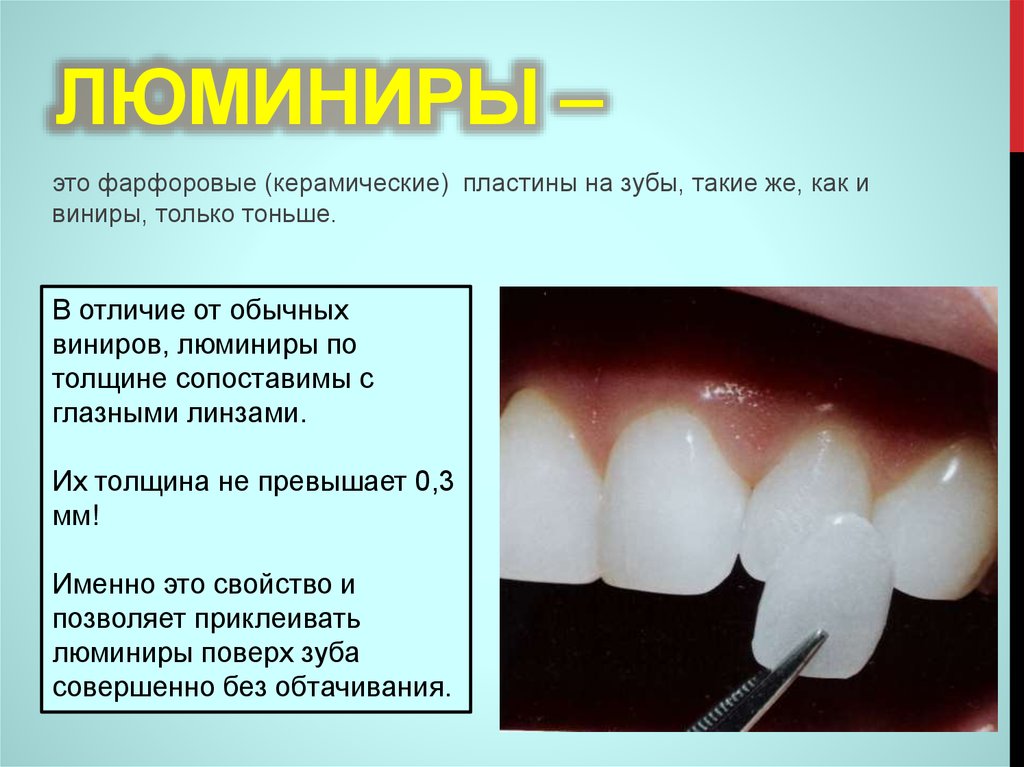 Не могу лизать у меня виниры песня. Композиционные виниры.