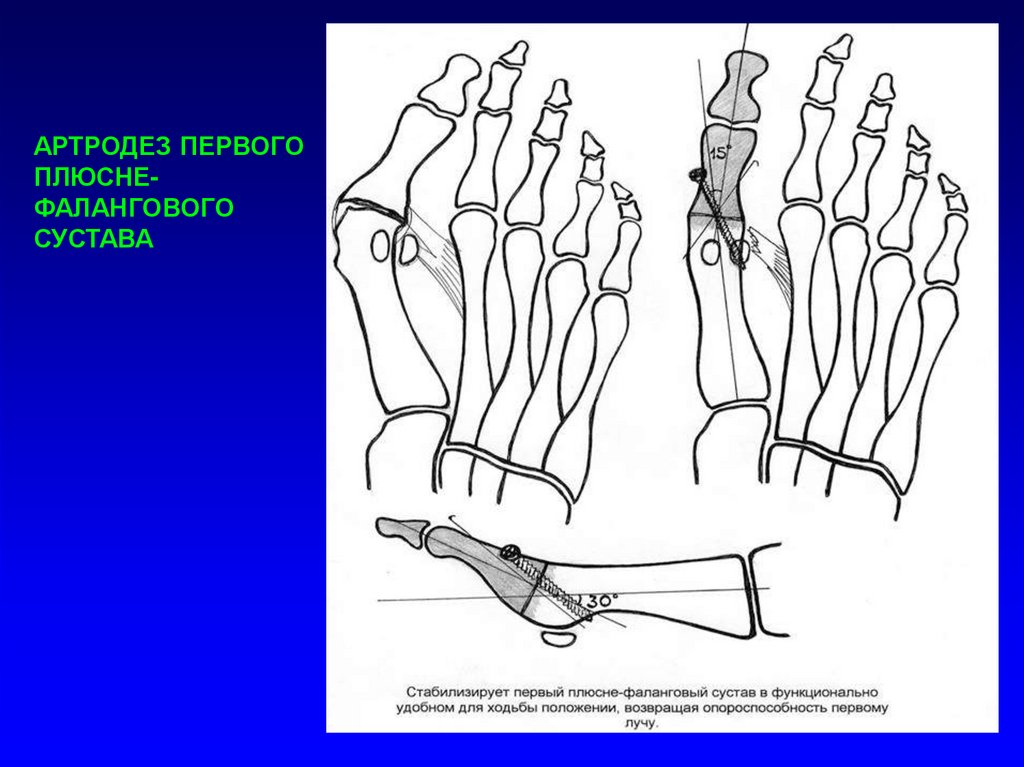 Плюсне фаланговые суставы. Артродез 1 плюснефалангового сустава. Проксимальная остеотомия 1 плюсневой кости стопы. Пластина для артродеза 1 плюснефалангового сустава. Поперечное плоскостопие травматология.