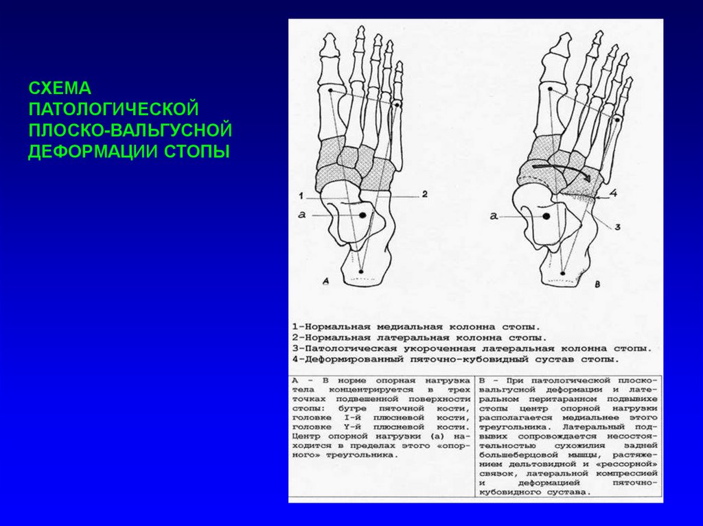 Углы стопы. Вальгусная деформация схема. Вальгусная деформация стопы измерения рентген. Вальгусная деформация стопы рентген описание. Вальгусная деформация стопы степени по рентгену.