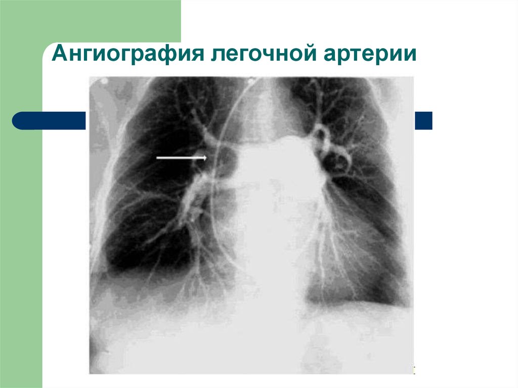Тромбофлебит легких. Ангиопульмонография Тэла. Тромбоэмболия пневмония кт. Тромбоэмболия ветвей легочной артерии рентген.