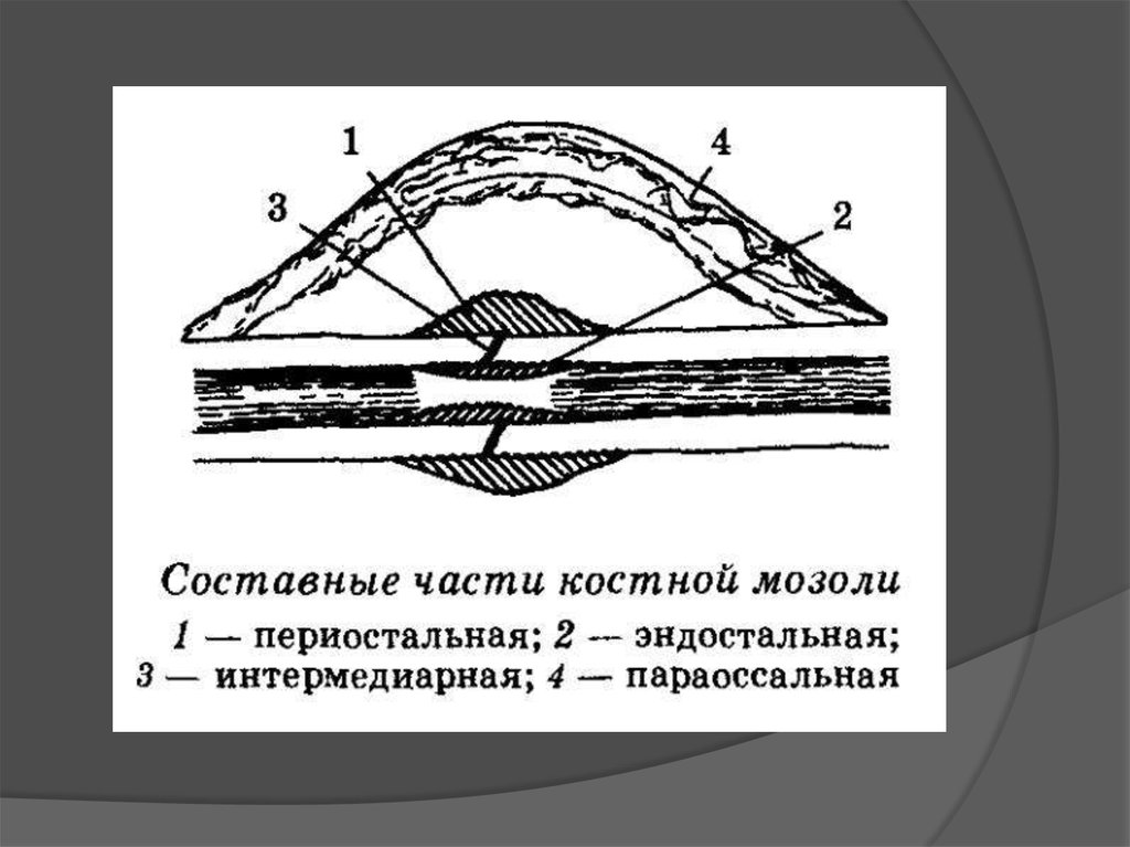 Костная мозоль. Источники образования костной мозоли. Эндостальная костная мозоль. Этапы образования костной мозоли. Фазы формирования костной мозоли.