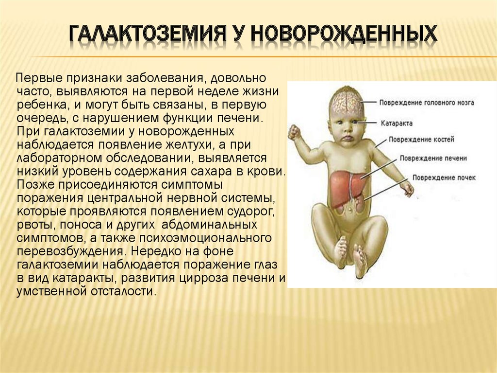 Увеличена печень у новорожденного. Клинические симптомы галактоземии. Галактоземия у новорожденных. Презентация на тему галактоземия.
