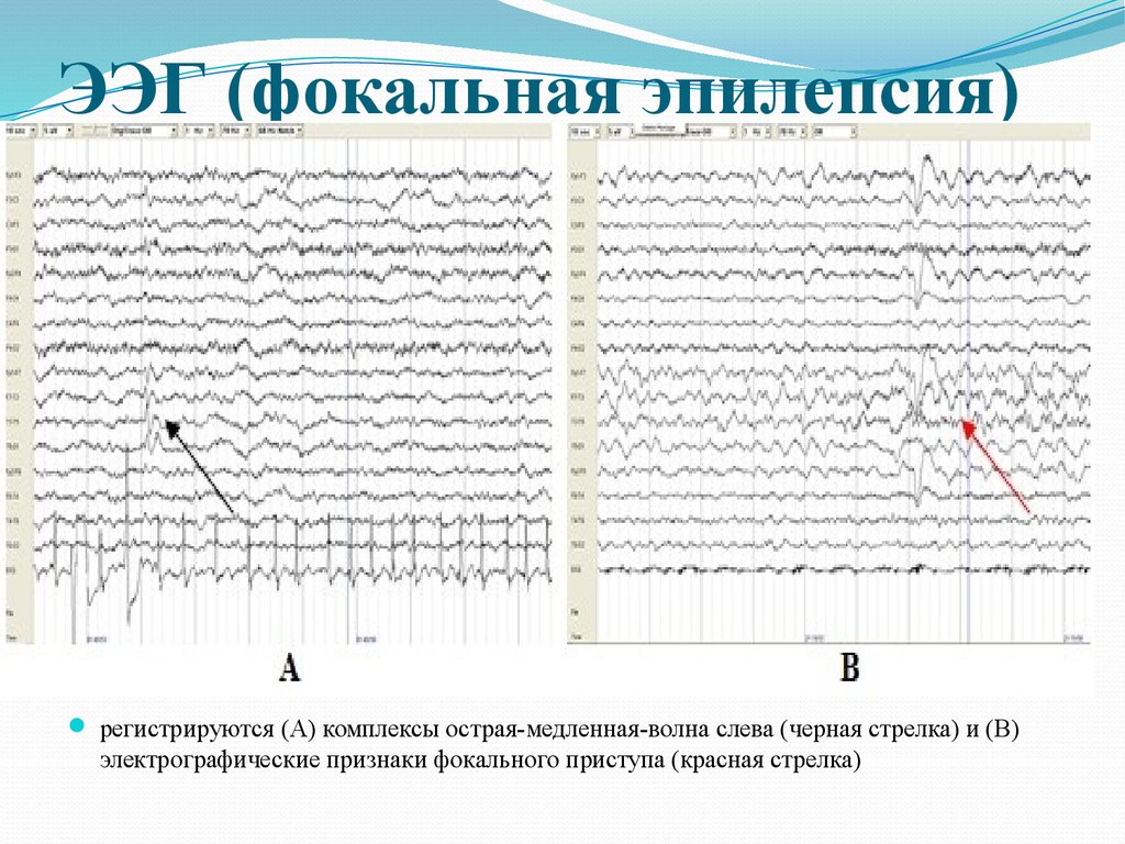 Медленные волны на ээг. ЭЭГ больного эпилепсией. Региональная эпилептиформная активность ЭЭГ. ЭЭГ головного мозга больного эпилепсией. Генерализованная эпилепсия ЭЭГ.