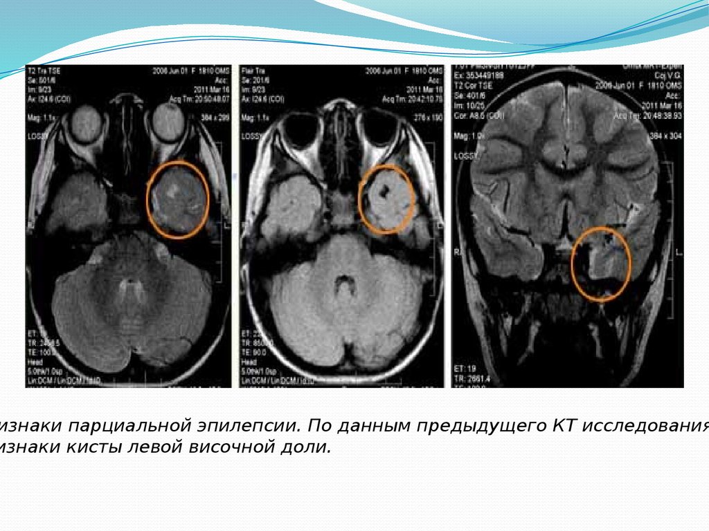 Признаки кисты. Эпилепсия в левой височной доли. Киста в левой височной доли кт. Кт и мрт при эпилепсии. Парциальная эпилепсия.