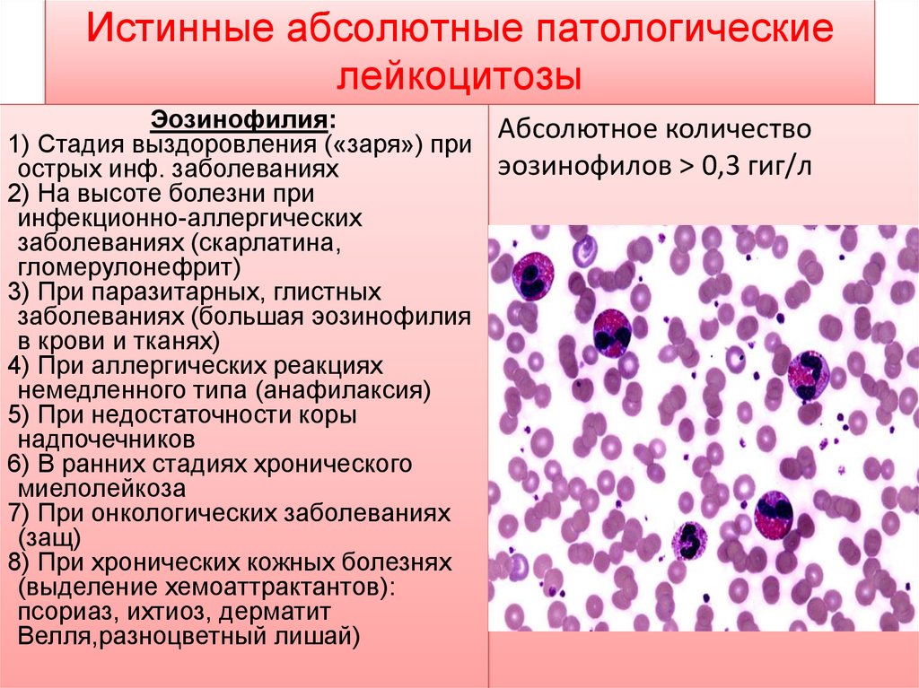 Что значит лейкоцитоз. Эозинофильный лейкоцитоз картина крови. Хронический миелолейкоз показатели лейкоцитов. Лейкоциты периферической крови. Анемия, лейкопения, повышение СОЭ.