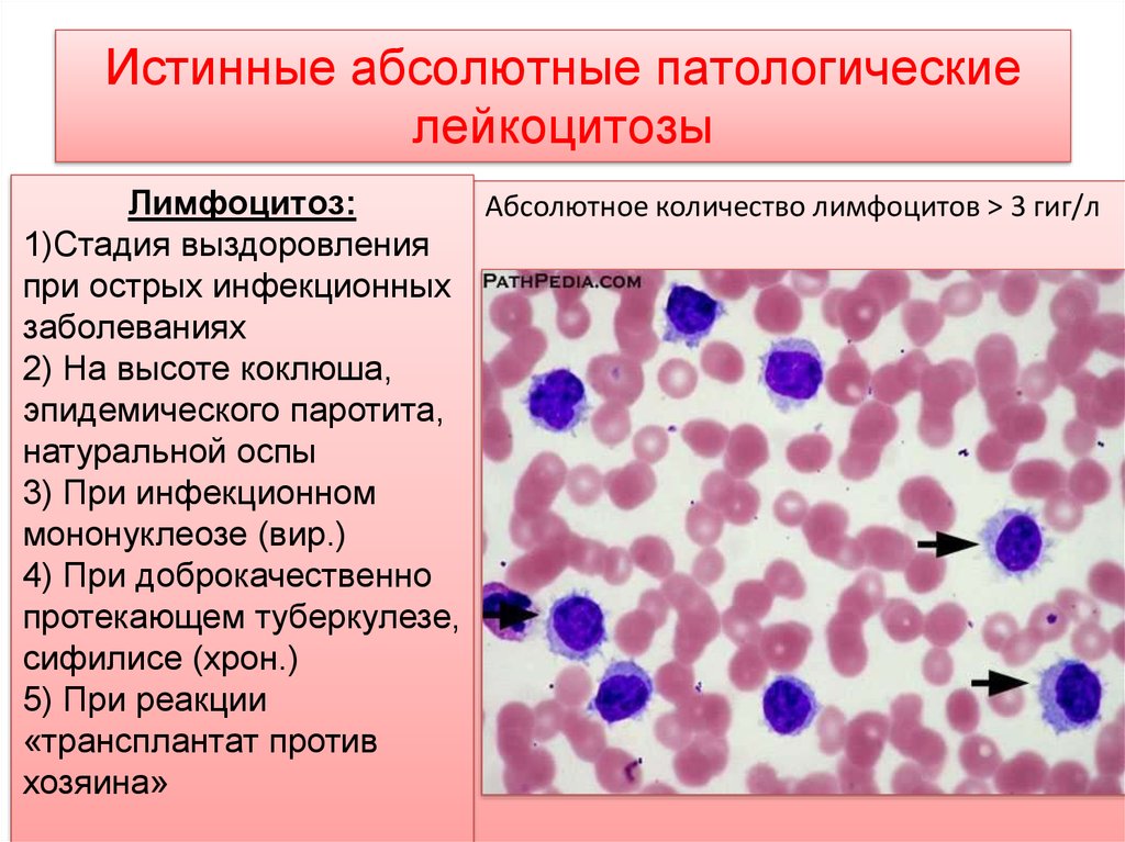 Изменения лейкоцитов в крови. Картина крови при нейтрофильном лейкоцитозе. Лейкоцитоз с лимфоцитозом. Снижение количества лимфоцитов. Изменения периферической крови.