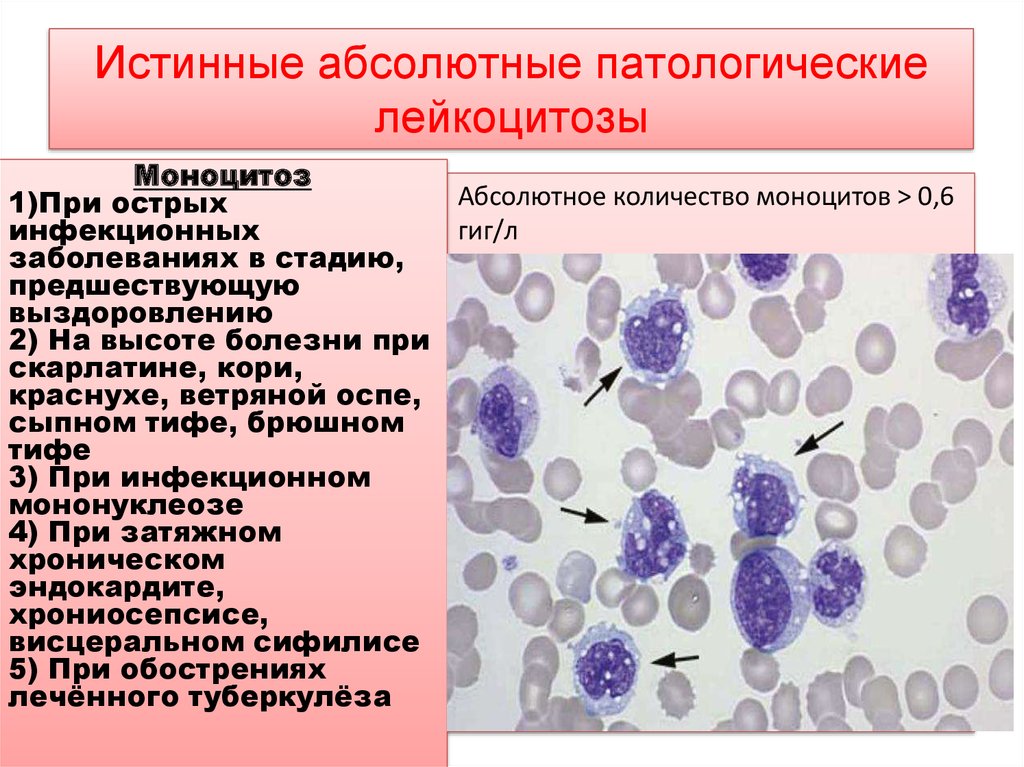 Моноцитов в крови 1. Хронический моноцитарный лейкоз. Лейкоцитоз с лимфоцитозом. Моноцитарный лейкоцитоз. Хронический лейкоцитоз.