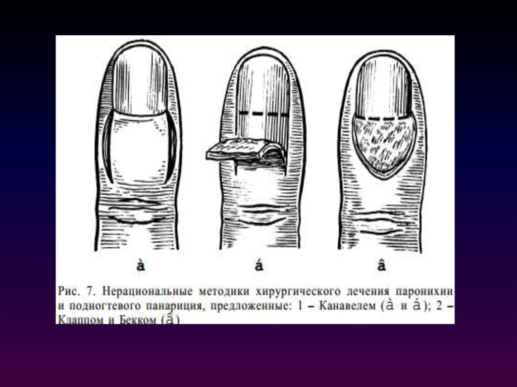 Панариций мазь. Панариций топографическая анатомия. Подногтевой панариций рентген. Травматический панариций. Эпидермальный панариций.