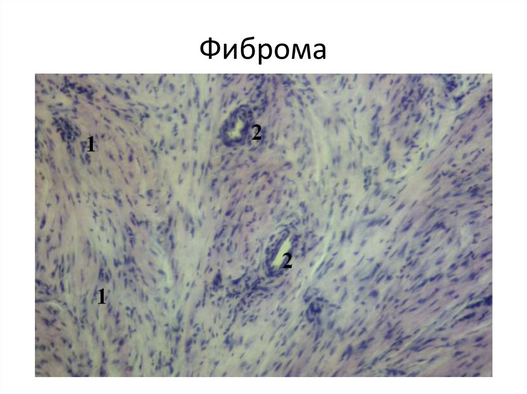 Фиброма микропрепарат рисунок