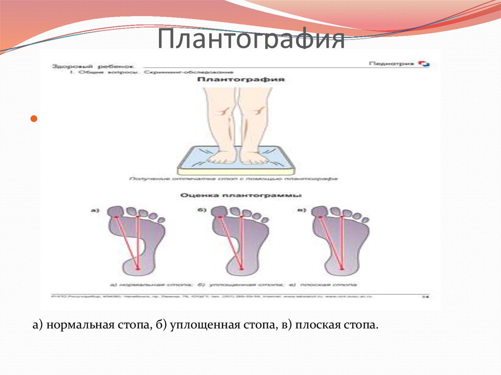 Плантография. Методика плантографии. Плантография стопы. Стопа нормальная уплощенная плоская.