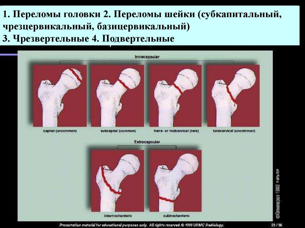 Закрытый перелом шейки бедра слева карта вызова