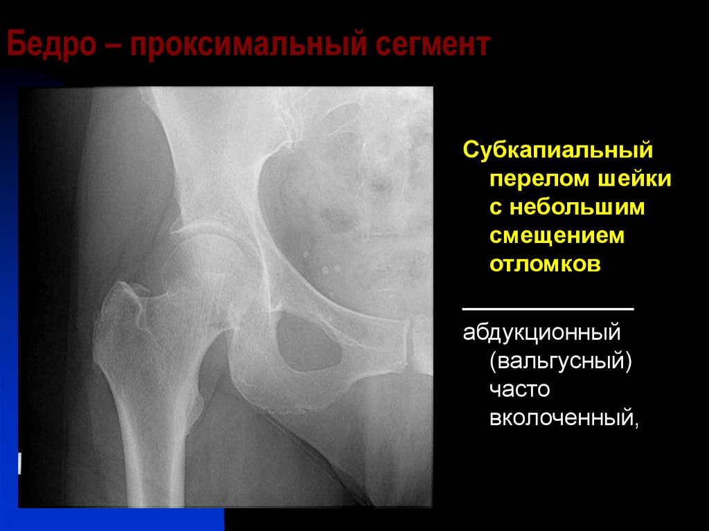 Закрытый перелом шейки бедра карта вызова скорой медицинской помощи