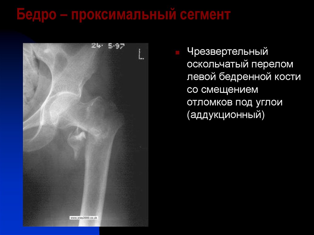 Чрезвертельный перелом бедренной кости со смещением отломков фото