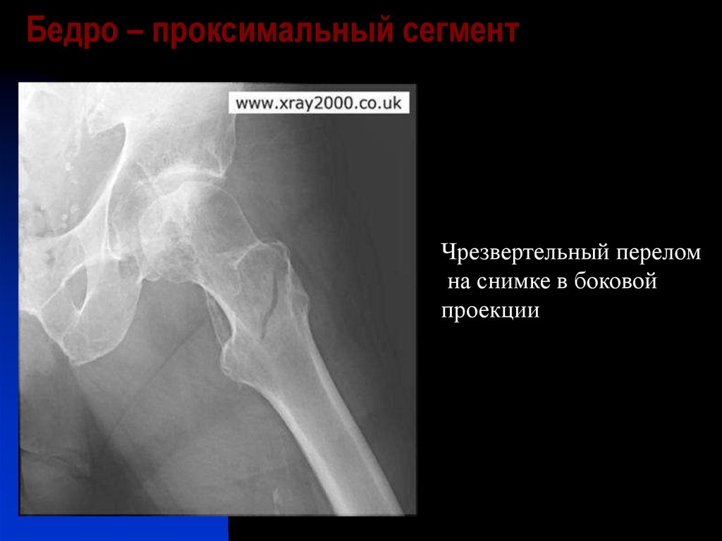 Переломы проксимального отдела бедренной кости презентация