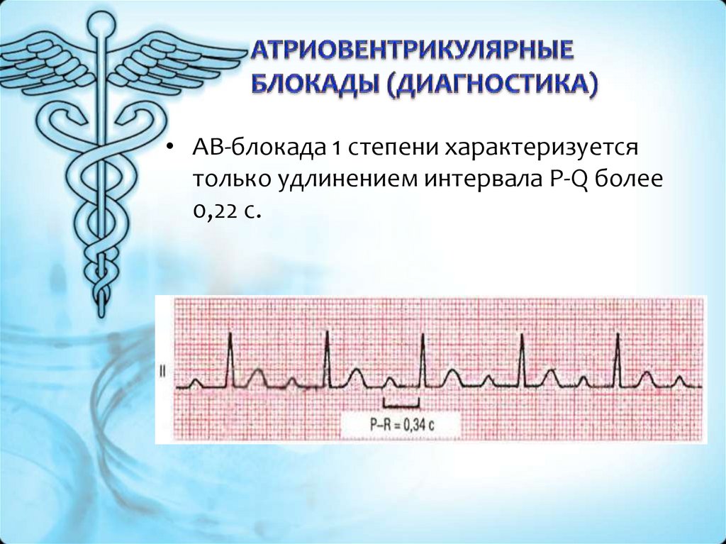Блокада боли челябинск. Полная АВ блокада диагноз. Атриовентрикулярные блокады. Для атриовентрикулярной блокады III степени характерно:. Атриовентрикулярная блокада дифференциальная диагностика.