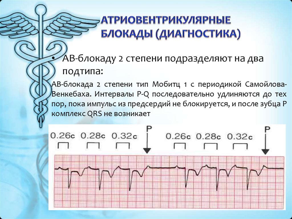 Атриовентрикулярная блокада признаки. Атриовентрикулярная блокада на ЭКГ. Полная АВ блокада диагноз. Критерии атриовентрикулярной блокады. Атриовентрикулярная блокада клинические проявления.