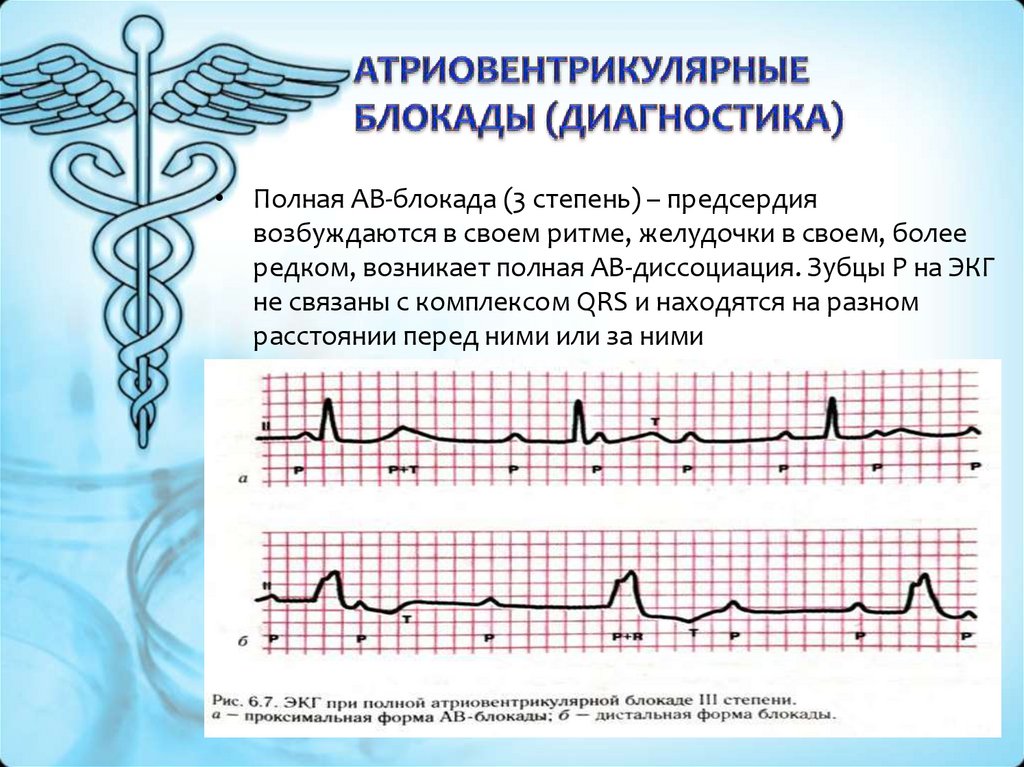 Экг презентация терапия