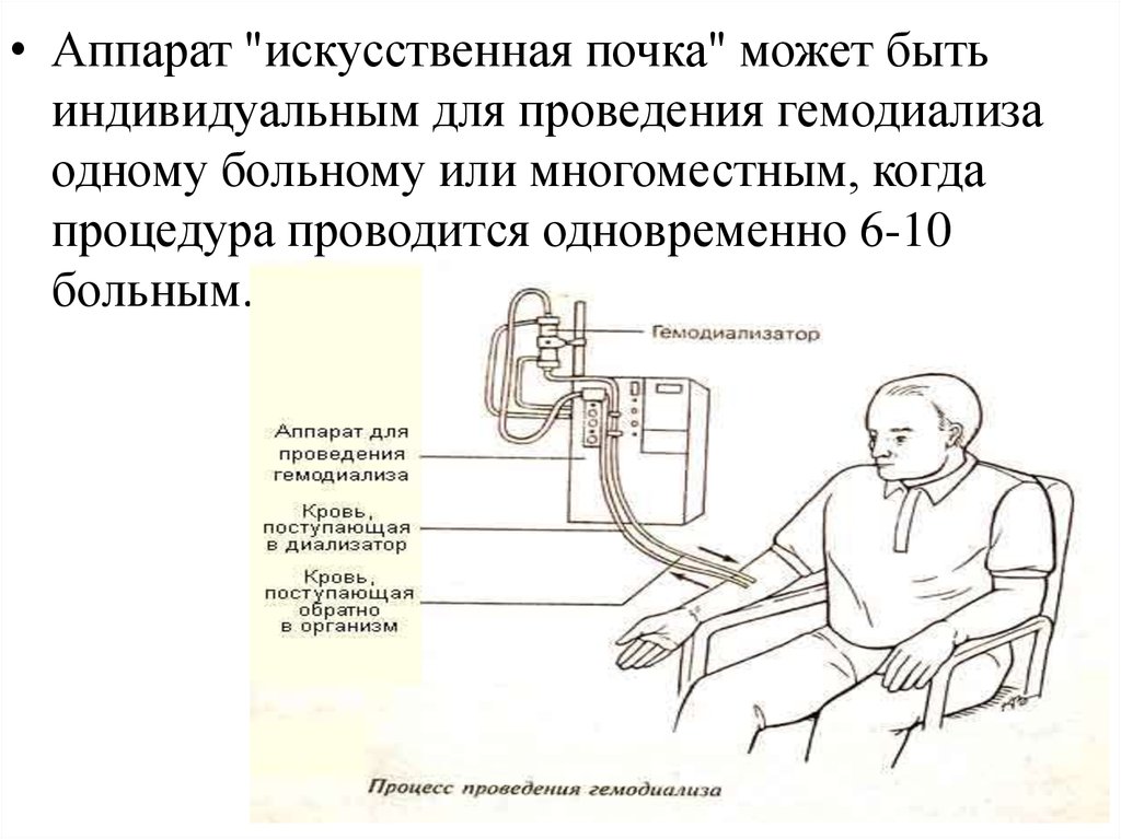 Гемодиализ почек сколько