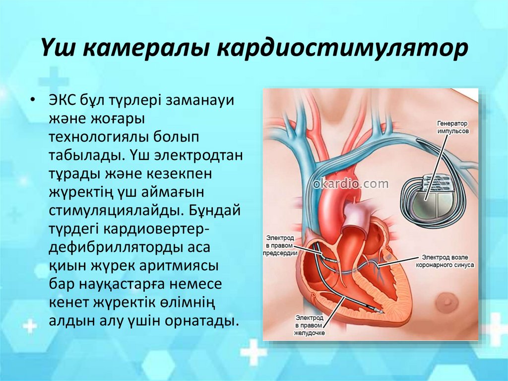 Электроды кардиостимулятора. Схема подключения кардиостимулятора. Почему в инструкции людям с кардиостимуляторами запрещается
