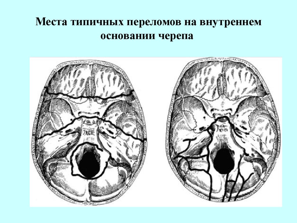 Для перелома основания черепа характерно. Перелом основания черепа ликворея. Перелом основания черепа через переднюю черепную ямку. Перелом основания черепа анатомия. Перелом черепа у основания передней ямки.