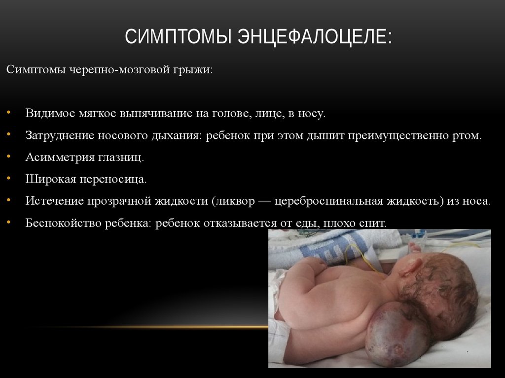 Симптомы Энцефалоцеле: