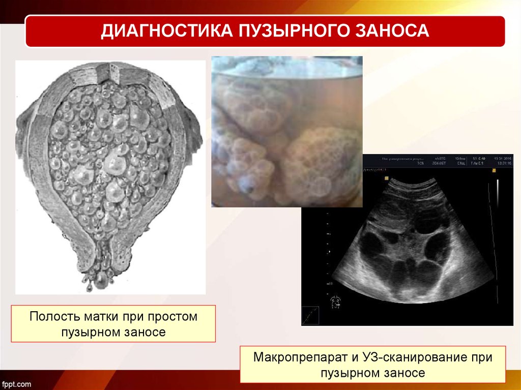 Пузырный занос презентация