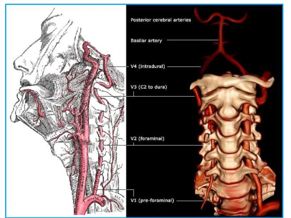 Где находятся позвоночные артерии у человека фото