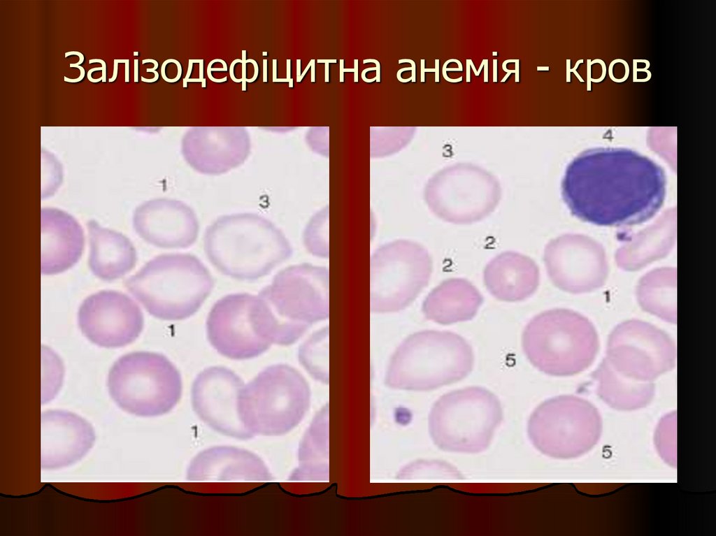 Нормоциты фото под микроскопом