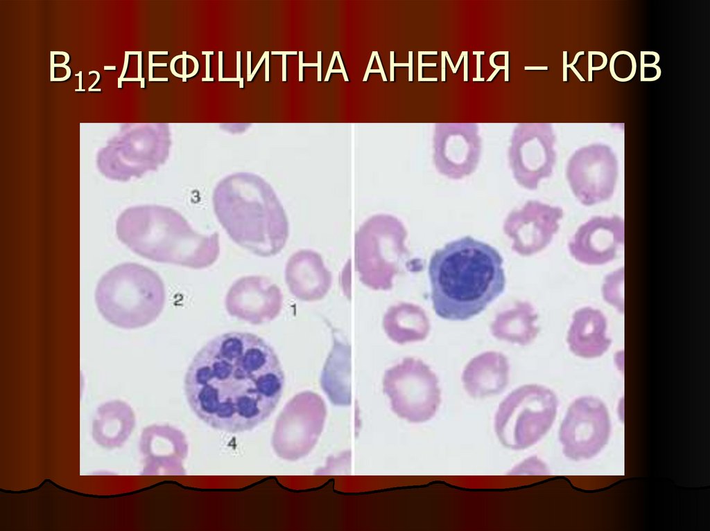 Пернициозная анемия препараты