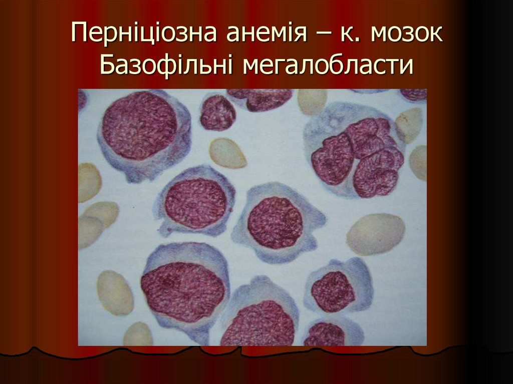 Злокачественное малокровие. Пернициозная анемия Аддисона-Бирмера. В12-пернициозная анемия. Пернициозная анемия мазок крови. Пернициозная анемия симптомы.