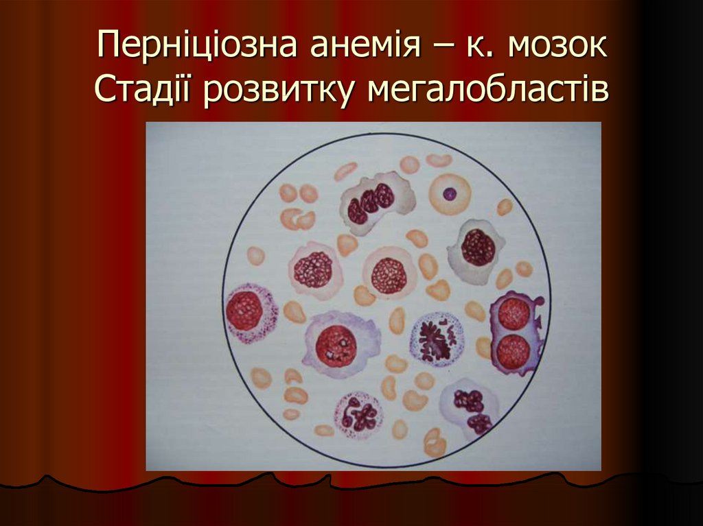 Пернициозная анемия. Картина крови при пернициозной анемии.