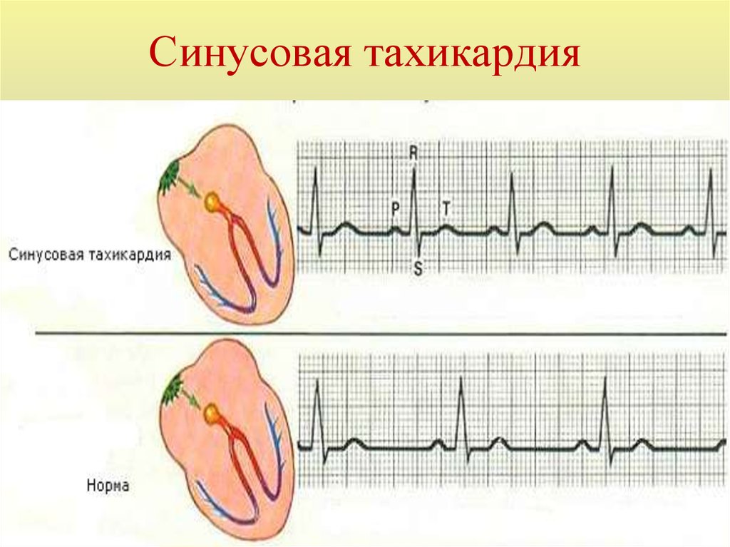 Быстрое сердцебиение