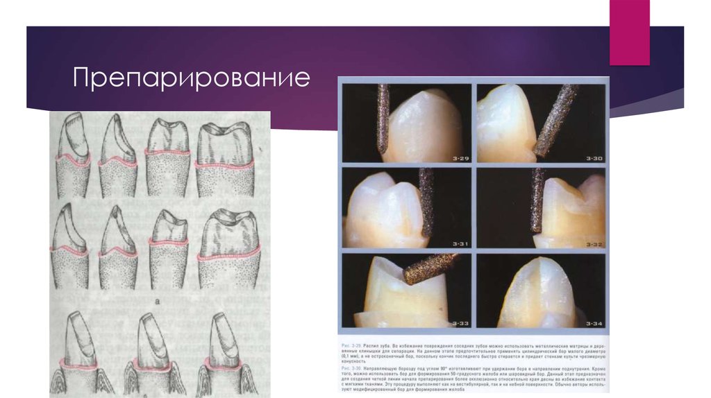 Штампованные коронки презентация