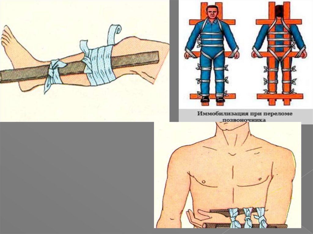 Шина при переломе. Транспортная иммобилизация при переломах. Иммобилизация при переломе спины. Иммобилизация при открытых переломах. Иммобилизация при переломе ноги.