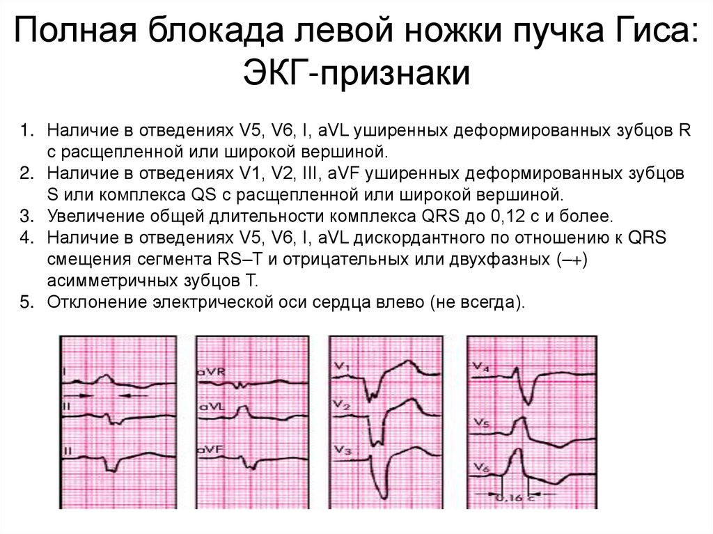 Неполная блокада правой ножки пучка гиса экг. ЭКГ критерии блокады левой ножки пучка Гиса. Полная и неполная блокада правой ножки пучка Гиса. ЭКГ критерии полной блокады левой ножки пучка Гиса. ЭКГ критерии полной блокады правой ножки пучка Гиса.