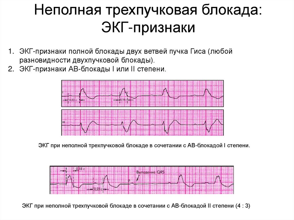 Блокада передней ветви левой ножки пучка гиса