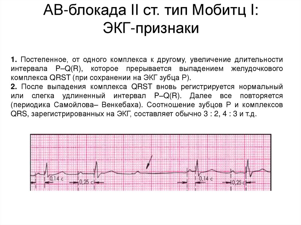 Полная атриовентрикулярная блокада