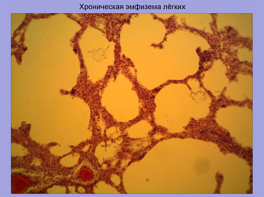 Эмфизема легких. Хроническая очаговая эмфизема легких микропрепарат. Обструктивная эмфизема лёгких микропрепарат.