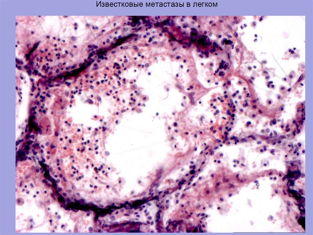 Как писать метастазы. Известковые метастазы в миокарде микропрепарат. Известковые метастазы в легких микропрепарат. Метастаз макропрепарат. Известковые метастазы в головном мозге микропрепарат.