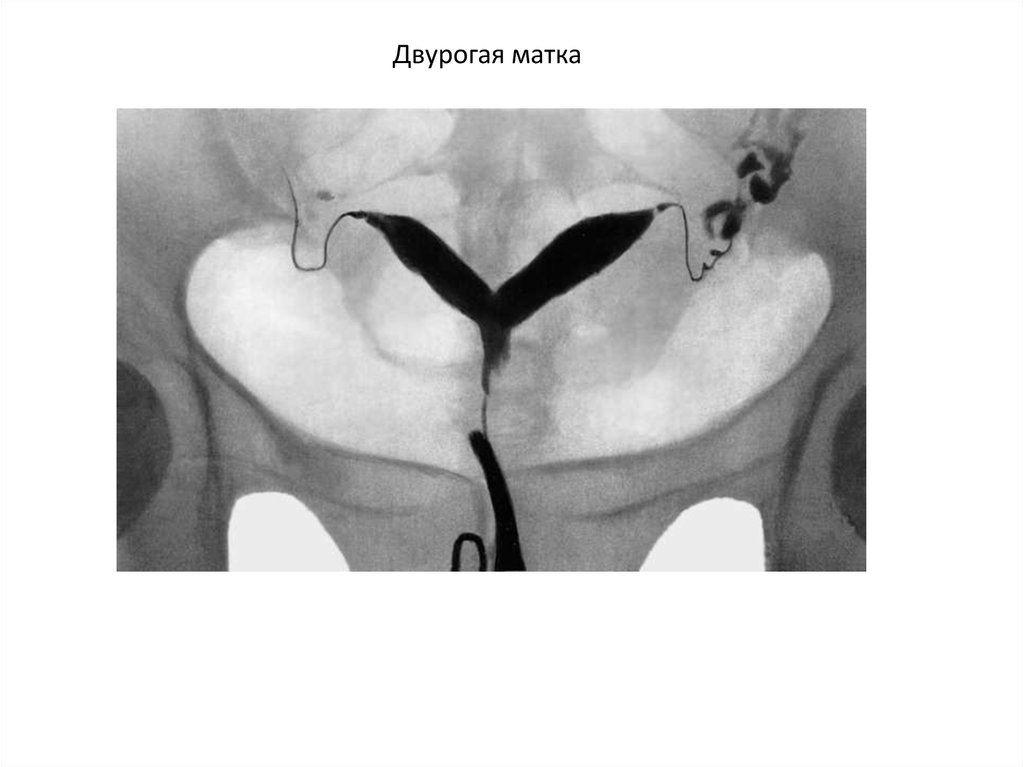 Методика гистеросальпингографии рисунок