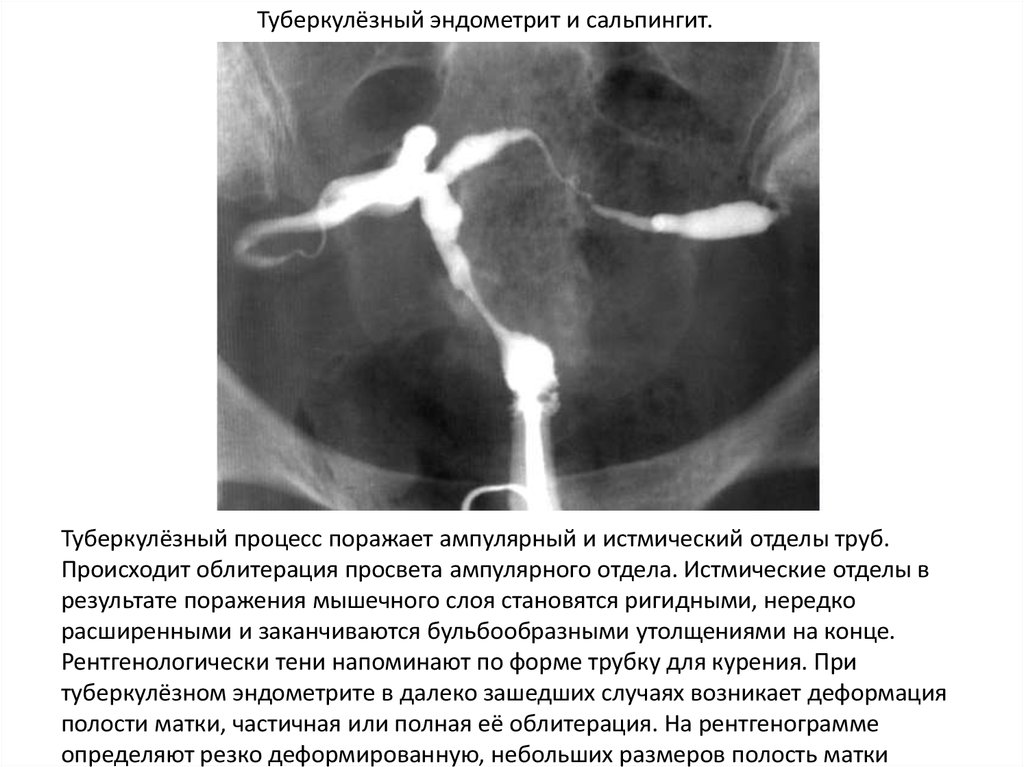 Гистеросальпингография эндометриоз